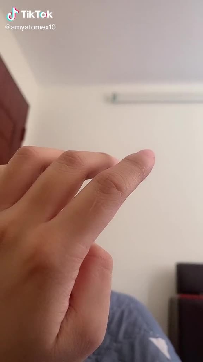 Chi chít sẹo nha 😜
